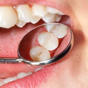Composite Fillings at Town & Country Smiles