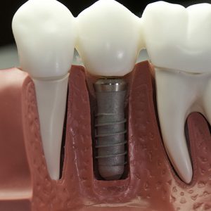 Dental Implants at Town & Country Smiles