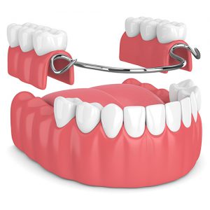 Dentures at Town & Country Smiles
