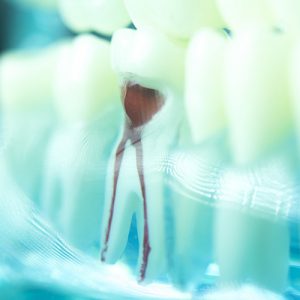Root Canals at Town & Country Smiles